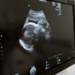 baby ultrasound - IVF timeline