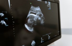 baby ultrasound - IVF timeline